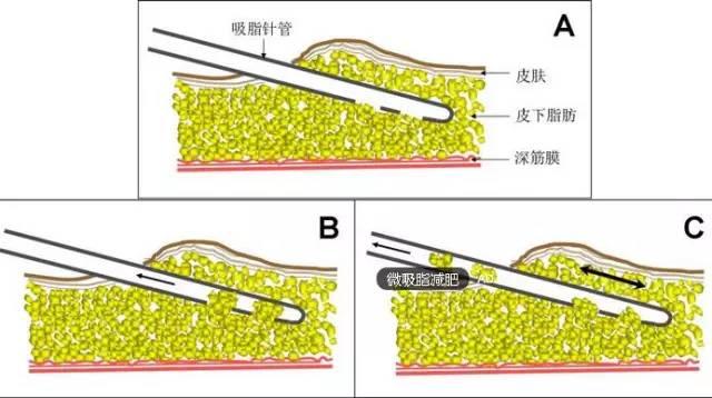 半永久化妝是微整形嗎？兩者有什么區(qū)別？